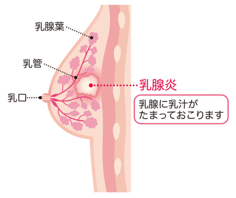 乳腺炎