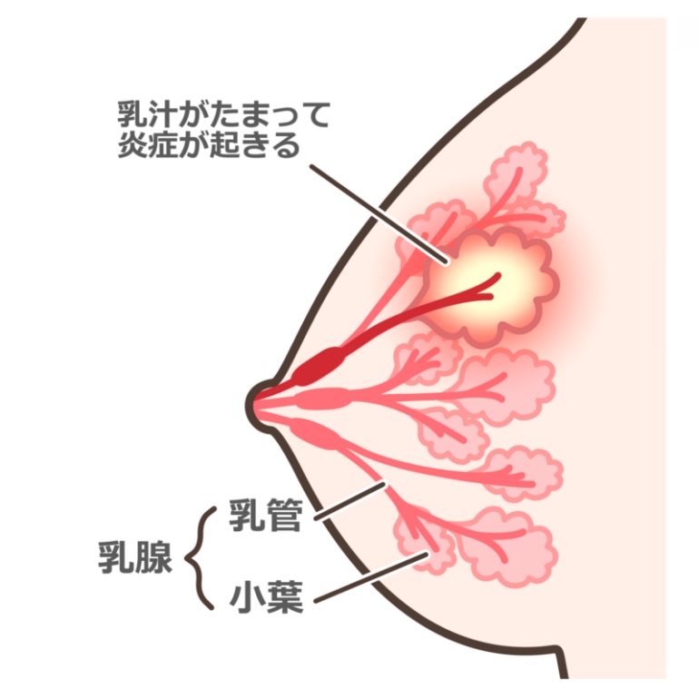 乳腺炎