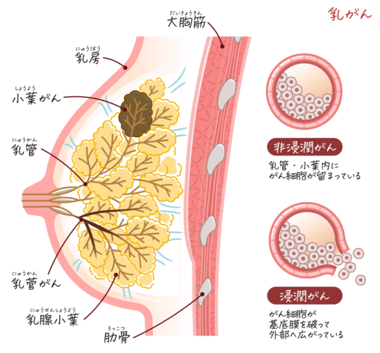 乳がん
