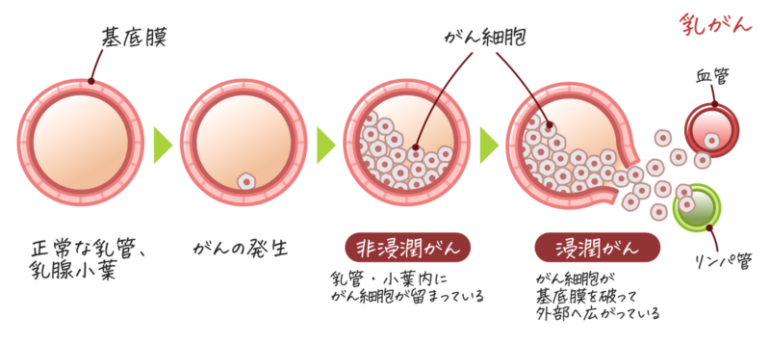 乳がん